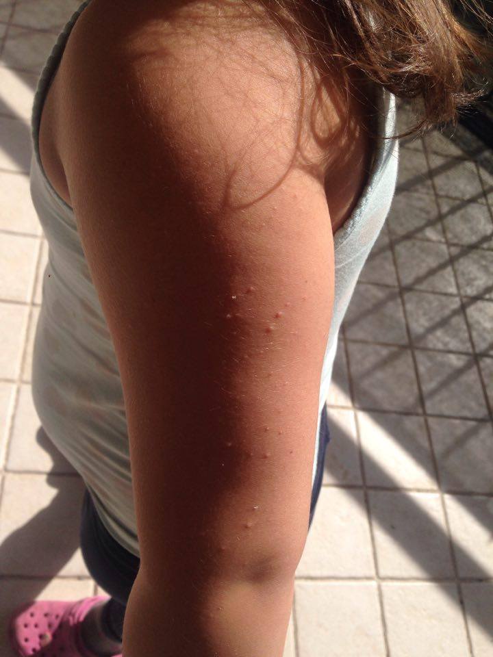 La dermatite che ha colpito la bimba di Claudia Spinuso - Foto Il Mediano